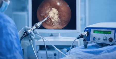 Pneumatic lithotripter used during minimally invasive kidney stone treatment procedure